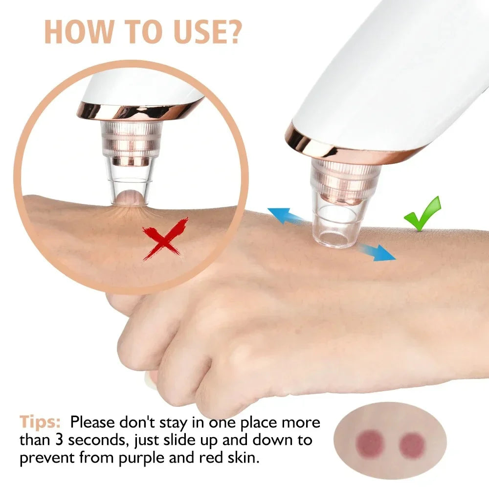 Blackhead Remover